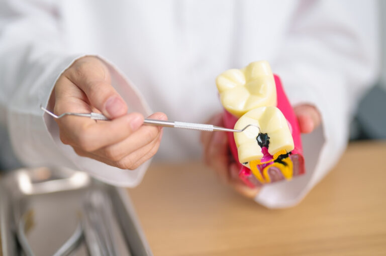 Cavities: Understanding Their Formation, Diagnosis, and Treatment - Mi ...
